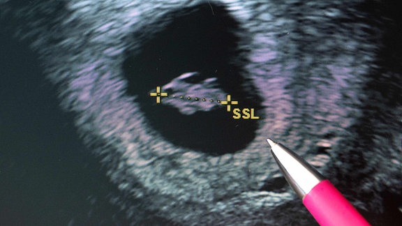 Ein Stift deutet auf den Fötus in einem Ultraschallbild