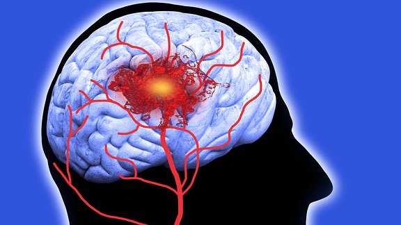 Grafische Darstellung eines Schlaganfalls