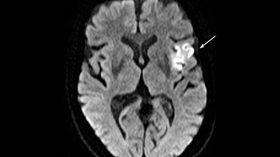 MRT-Bild von Gehirn mit akutem Schlaganfall aus "Reine Nervensache"